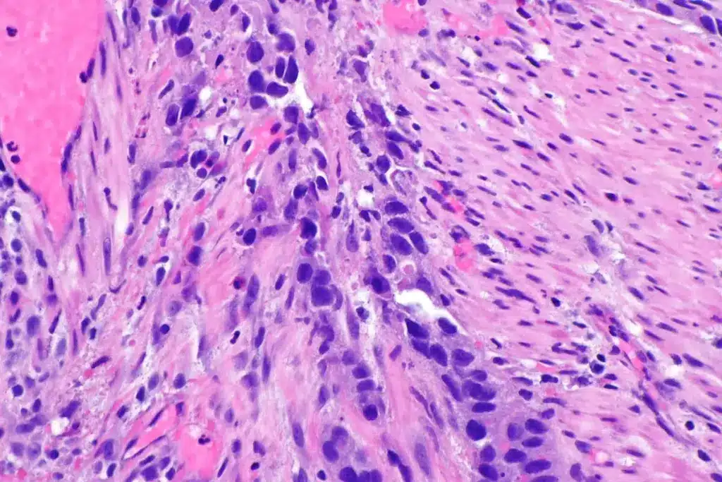 Massed Two-Story? No, Bladder Cancer Facts