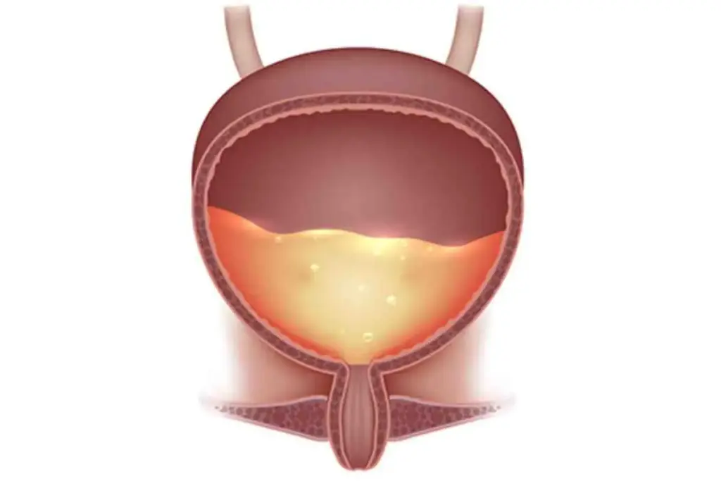 Distended Bladder: Best Vital Health Info 2 Distended Bladder: Best Vital Health Info