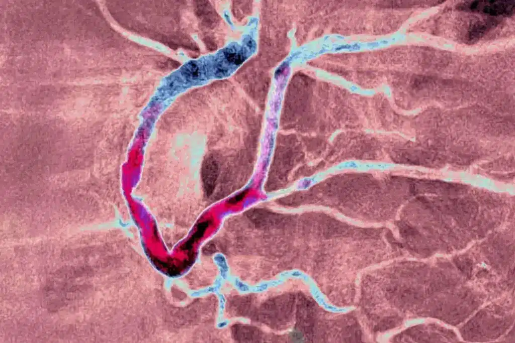 Myocardial Infarction: Ischemia Risk Info 2 Myocardial Infarction: Ischemia Risk Info