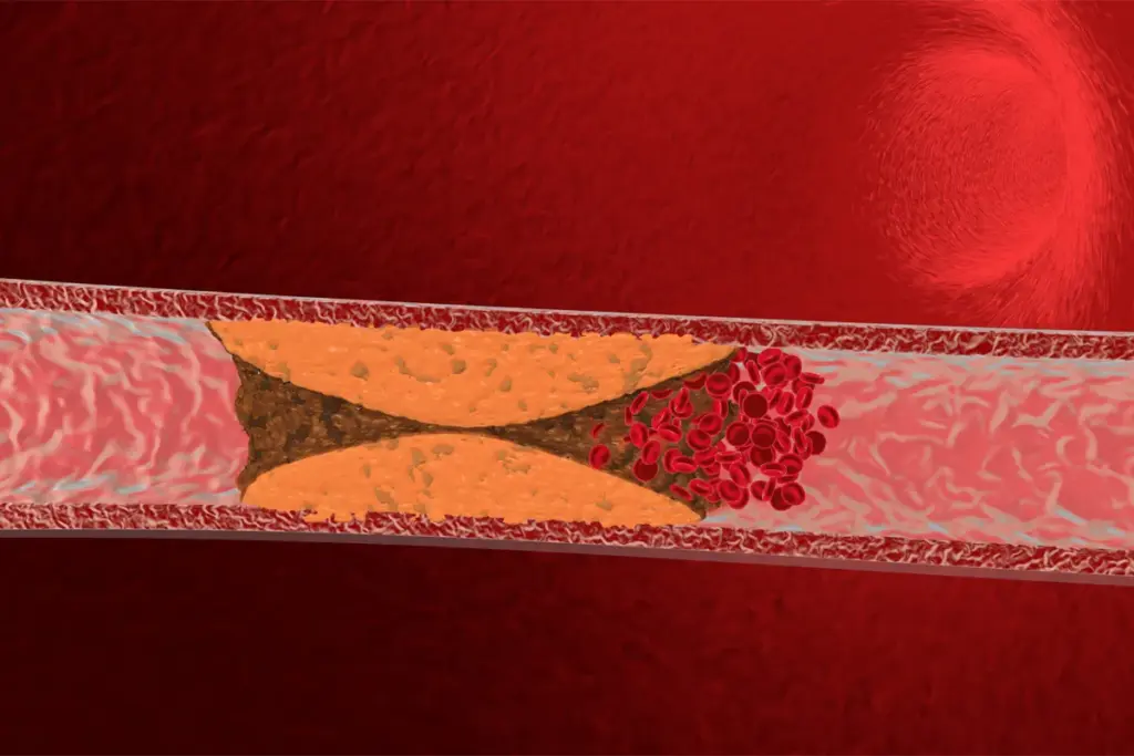 Is Cardiac Catheterization Needed If You Have 50 Percent Blockage