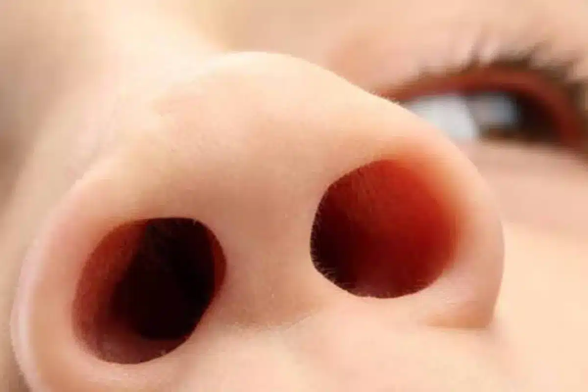 Nose Polyps Treatment Natural: Best Kids Tips