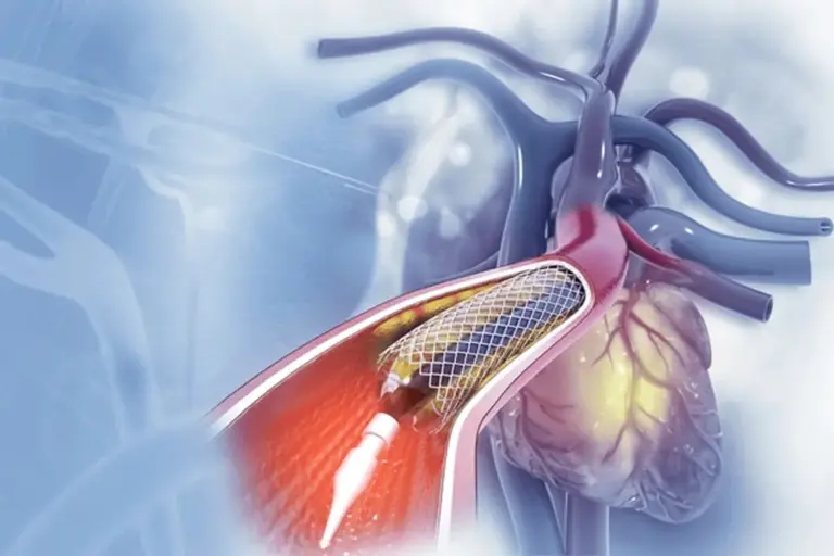 Cardiac Catheterization: Best Steps Info