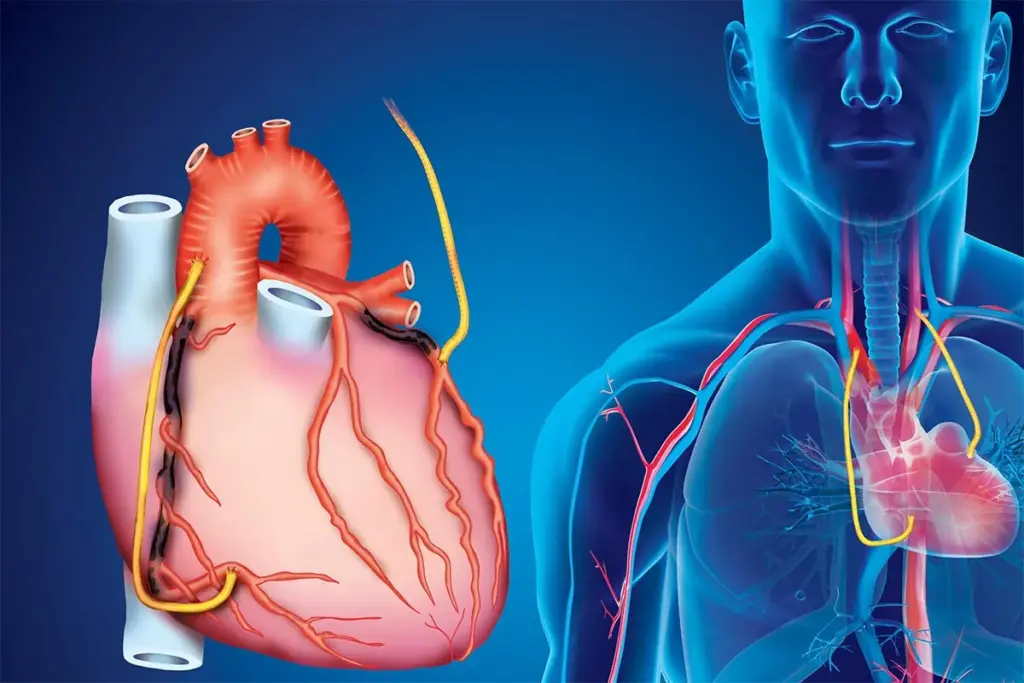 What Is A Stent Clog? Best Risk Facts 3 image 3 2460 LIV Hospital