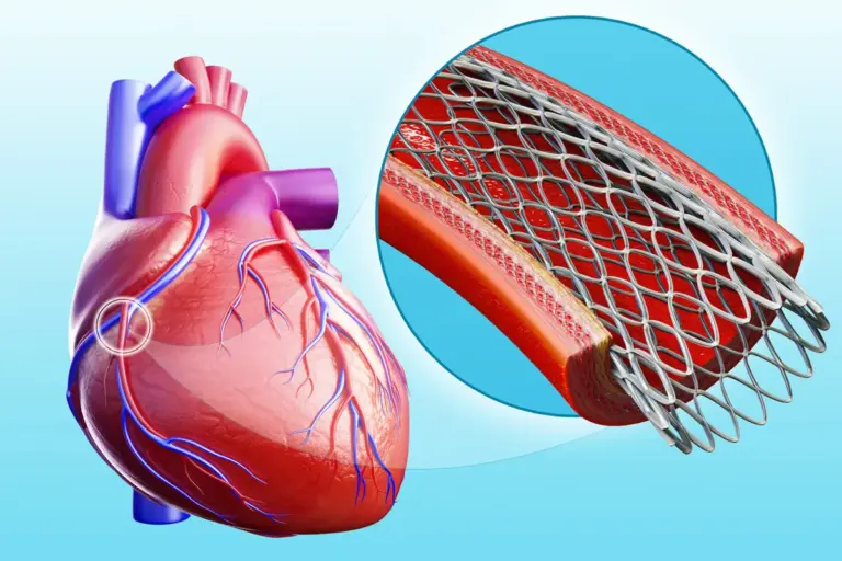 Clogged Arteries: Best Natural Fixes?