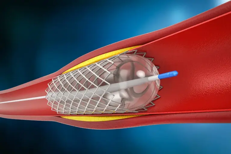 What Is A Stent Restenosis? Best Facts