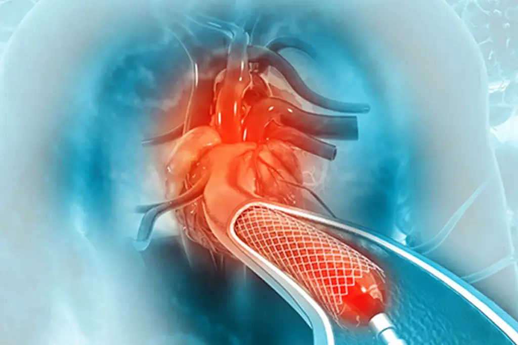 Do Angioplasty With Stenting Need Leg Straight? 2 Do Angioplasty With Stenting Need Leg Straight?