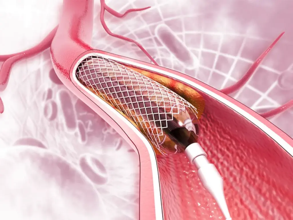 Stent Surgery After Bypass: Best Options 1 Stent Surgery After Bypass: Best Options