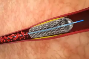 How Long Do Stents Last? Best Vital Info