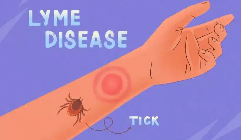 Lyme Disease