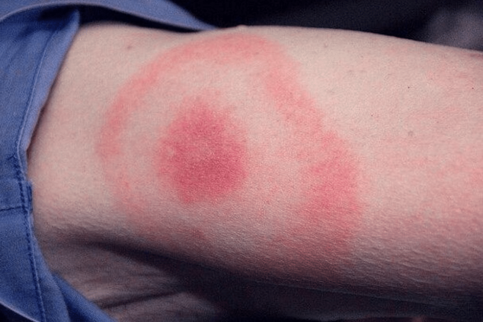 Kelly Osbourne Lyme Disease Recovery 3 Kelly Osbourne Lyme Disease