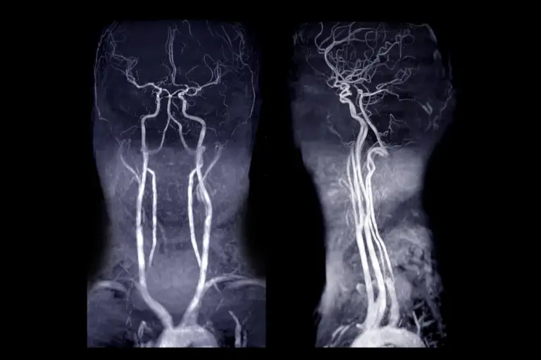 Angiogram CT: Best Accurate Heart Scan