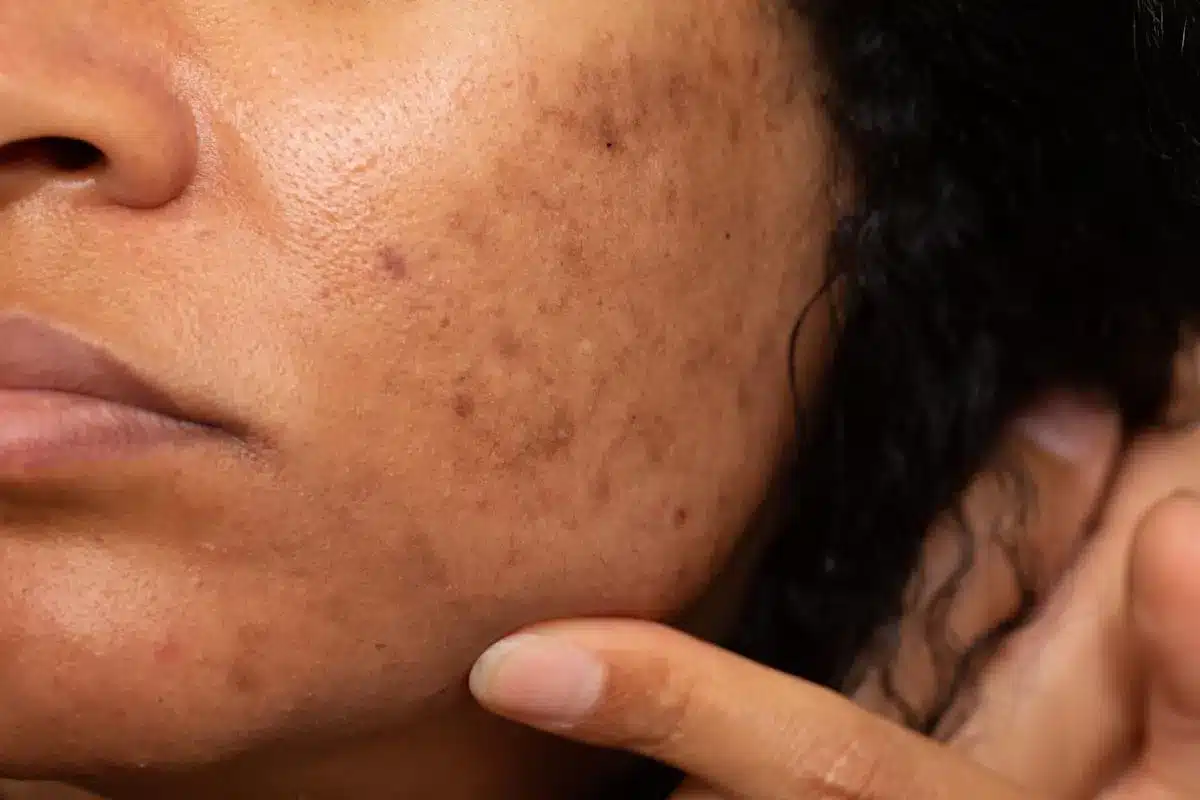 Valuable Do Chemical Peels Get Rid Of Blackheads: Remove Of Blackheads