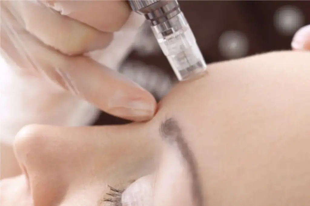 Key How Much Is Microneedling? 2 image 2 2132 LIV Hospital
