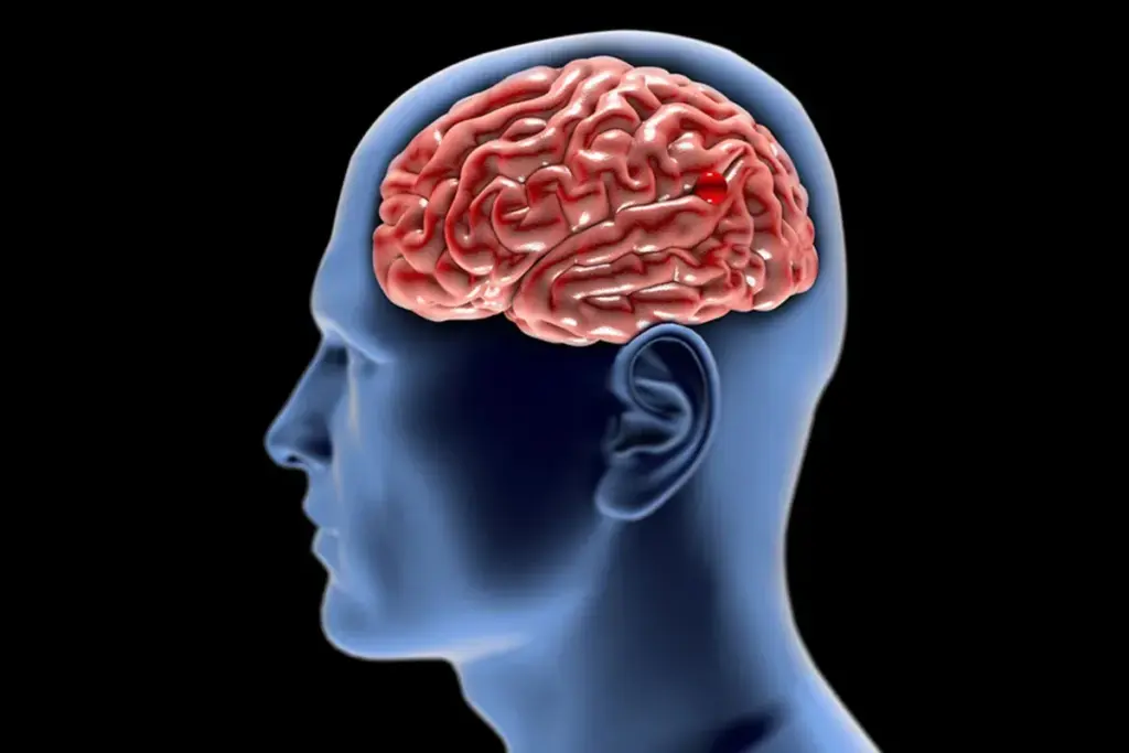 Valuable What Is Aneurysm Embolization (Aneurysm Coiling And Embolization)?