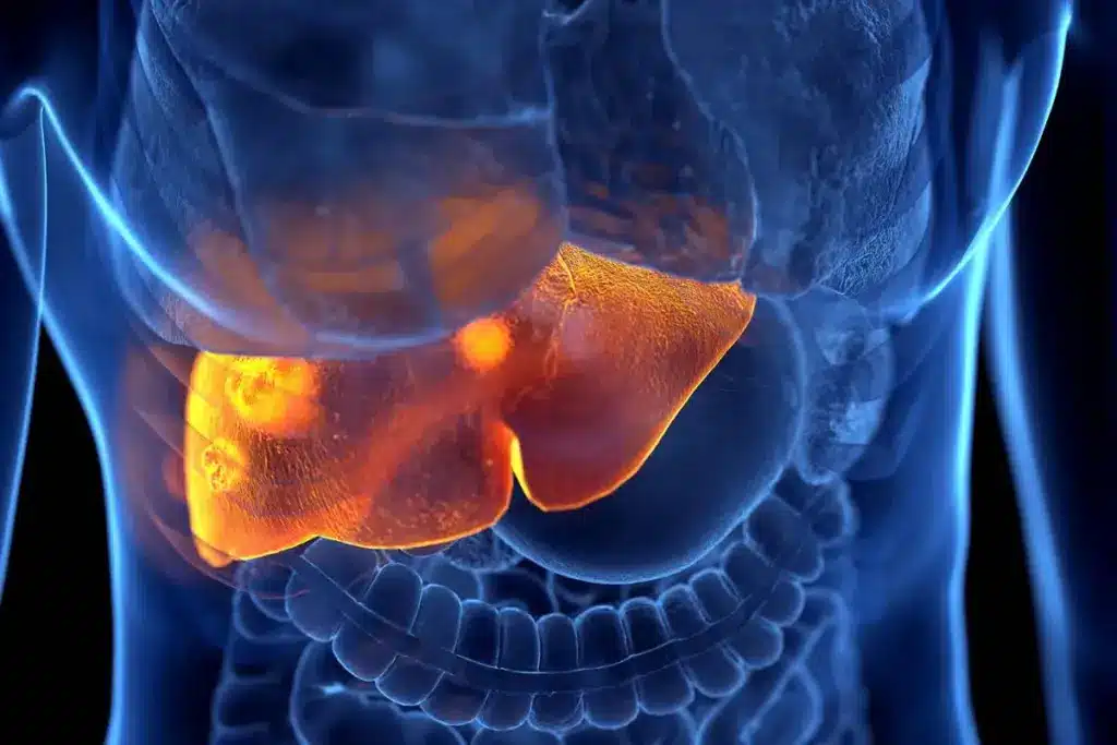 Simple What Is Liver Embolization (Liver Embolization Procedure)?