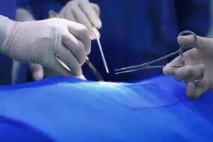 Most Successful Varicocele Surgery