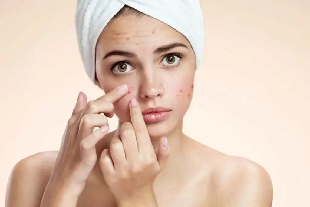 Sharp Does Toothpaste Help Acne (Toothpaste On Pimple)?