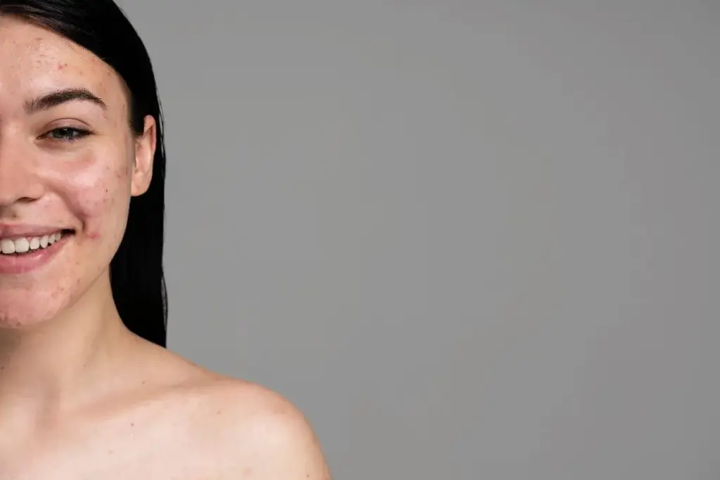 Valuable What Kills Acne Bacteria Naturally (Acne Treatment)?