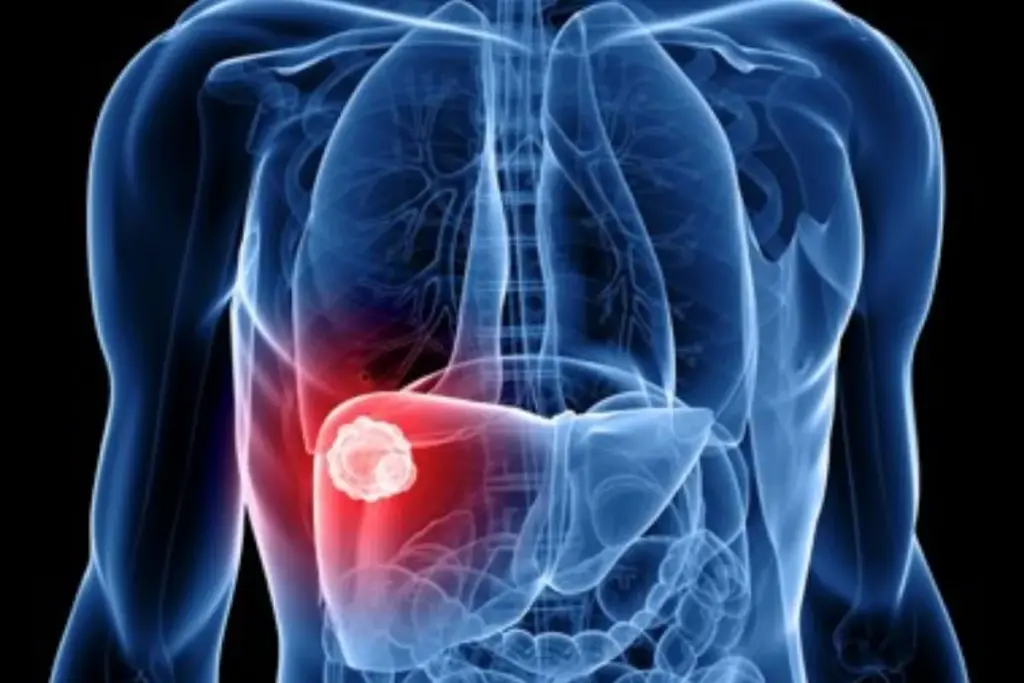 Essential What Does Y-90 Decay To (Y90 Decay)?