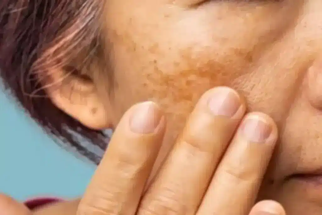 Amazing What Can Be Mistaken For Melasma (Melasma)?