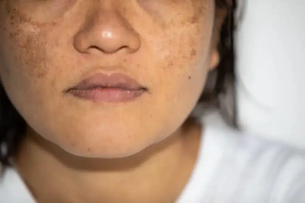 Insightful Is Melasma A Liver Problem (Melasma)?