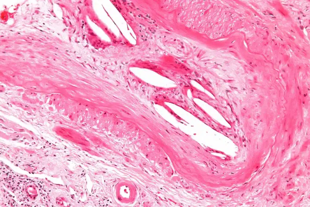 Varicocele Embolization Success