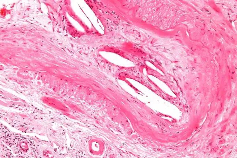 What Is Neutropenia: Key Facts You Should Know