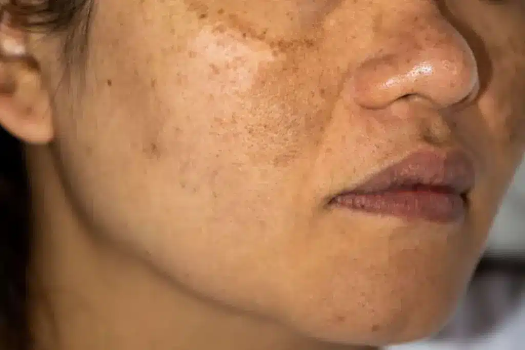 Amazing What To Eat To Help Melasma (Cure Of Melasma)?