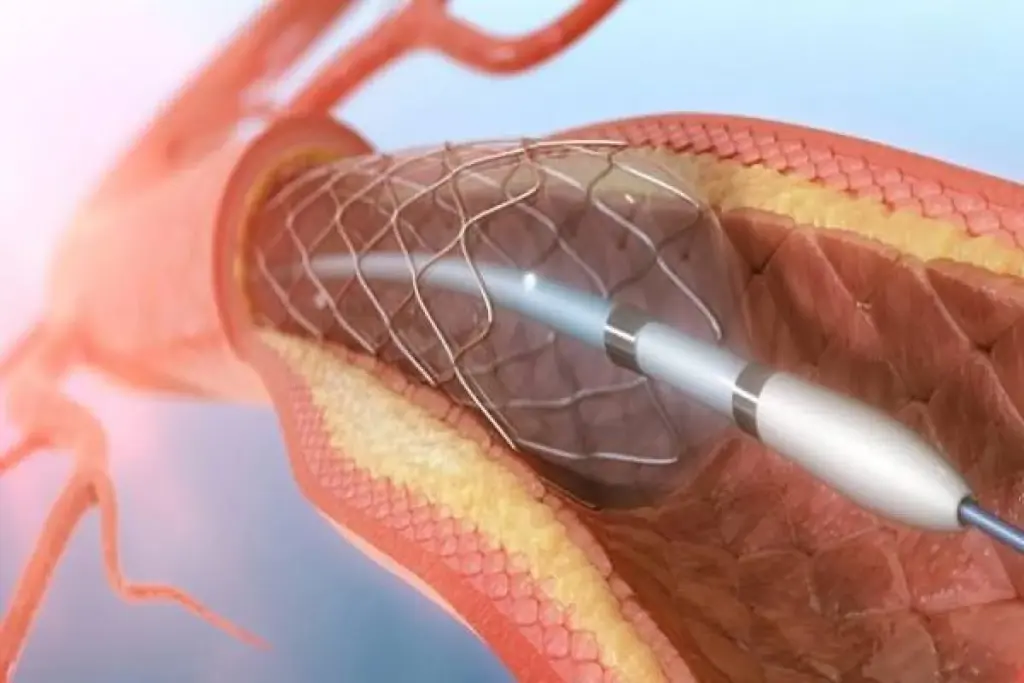 Complete Do You Need Blood Thinners After Stent?