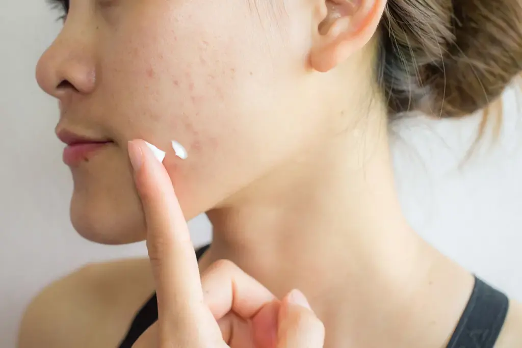 Simple Can Acne Be Cured (Acne)?