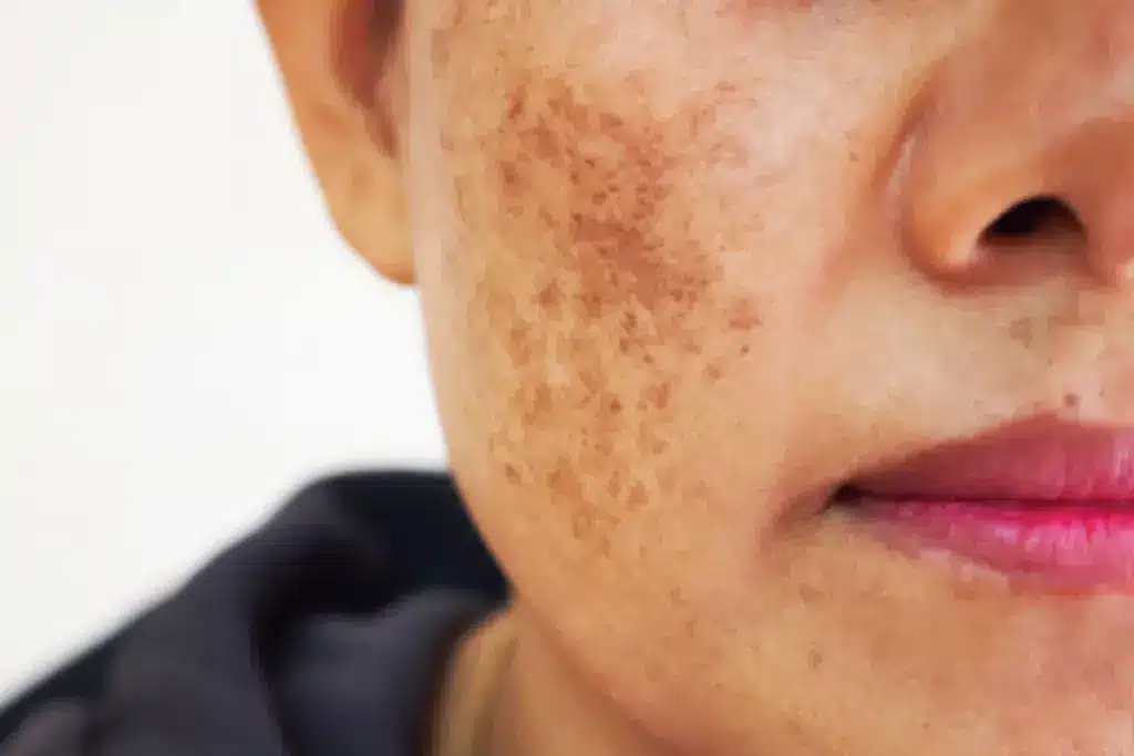 Guide Is Cerave Retinol Good For Melasma (Melasma Medicine)?