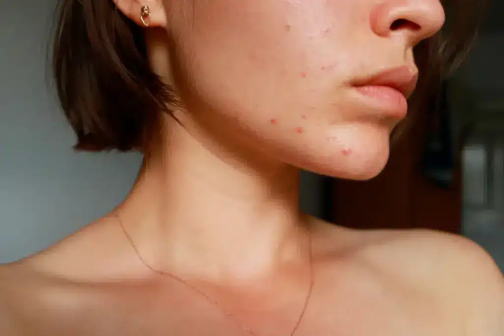 Insightful How To Treat Hormonal Acne (Acne)?
