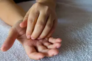 Key What Not To Say To Someone With Eczema: Eczema How To Say