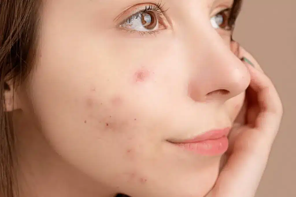 Profound Is Cetaphil Or Cerave Better For Acne: Cerave Vs Cetaphil