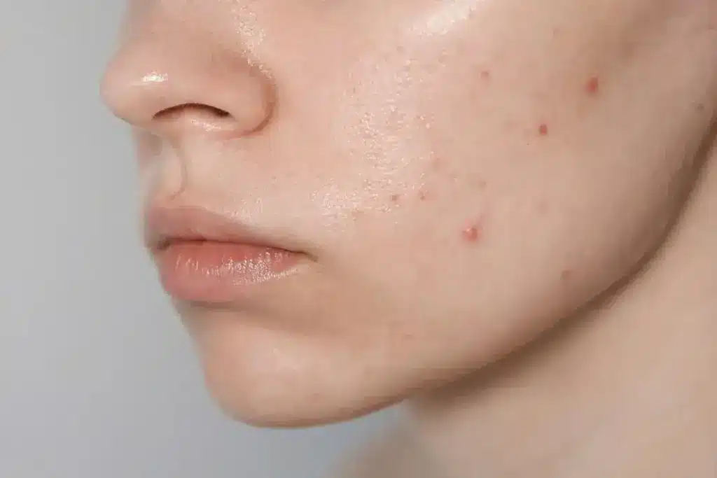 Fascinating What If My Acne Won't Stop: How To Get Rid Of Acne