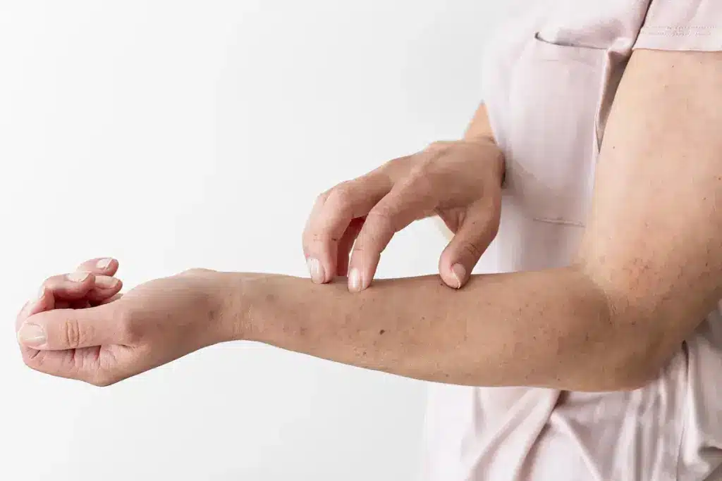 Simple What Happens If Urticaria Goes Untreated (Hives)?