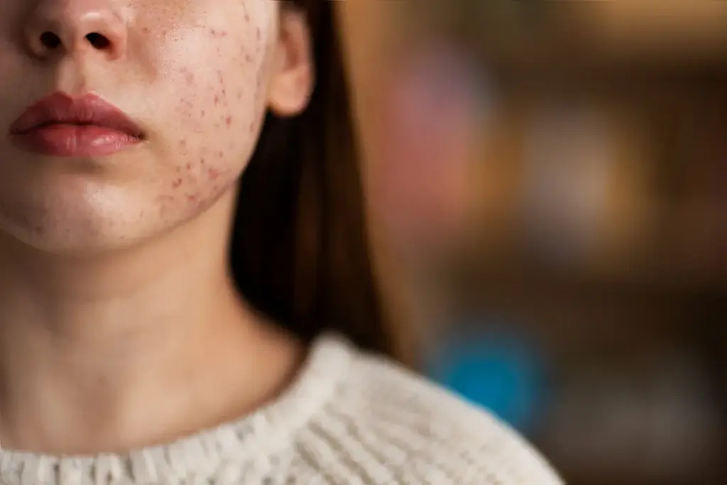 Fascinating What If My Acne Won't Stop: How To Get Rid Of Acne