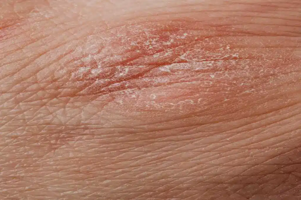 Crucial How To Permanently Heal Eczema (Eczema)?