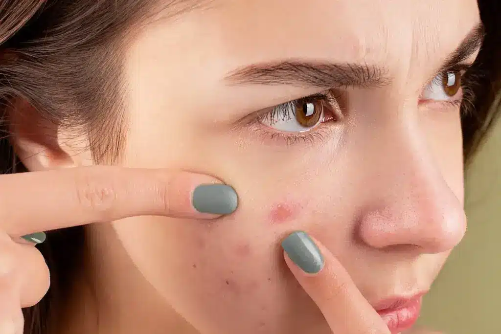 Essential Can Being Run Down Cause Acne (Acne)?