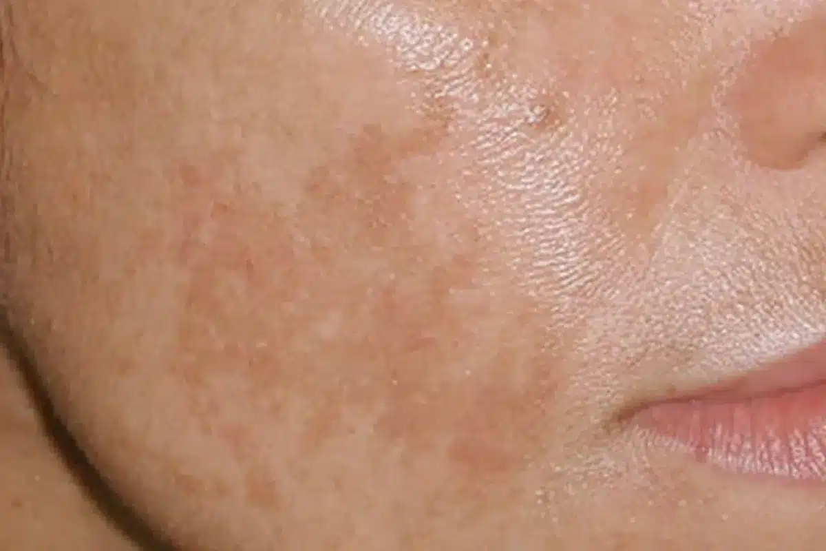 Insightful Is Urticaria A Form Of Lupus (Lupus Rash)?