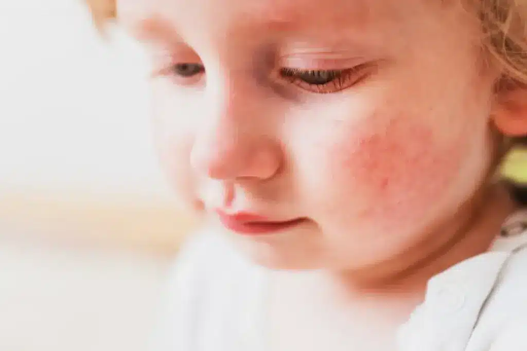 Profound What Is Mistaken For Urticaria (Urticaria Vs Rash)?