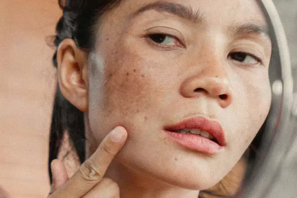 Crucial What Age Is Acne The Worst?