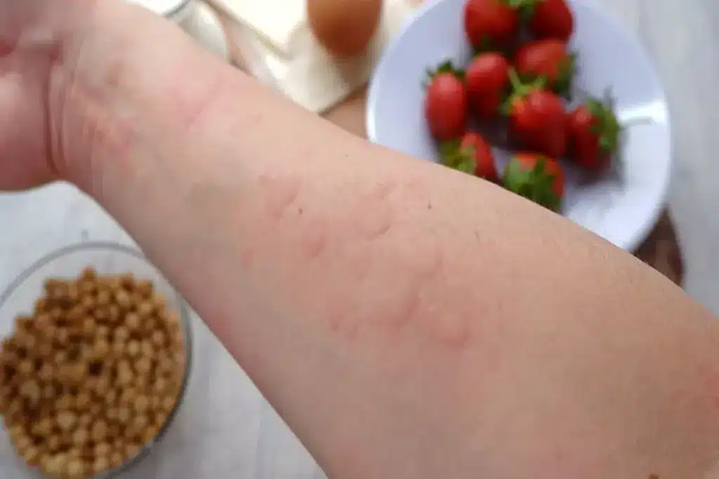 Ultimate Is Urticaria A Blood Infection: Diseases That Cause Hives In Adults