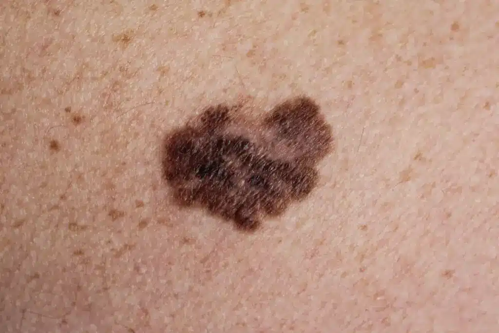 Simple What Percent Of Skin Biopsies Are Cancerous (Benign Mole)?