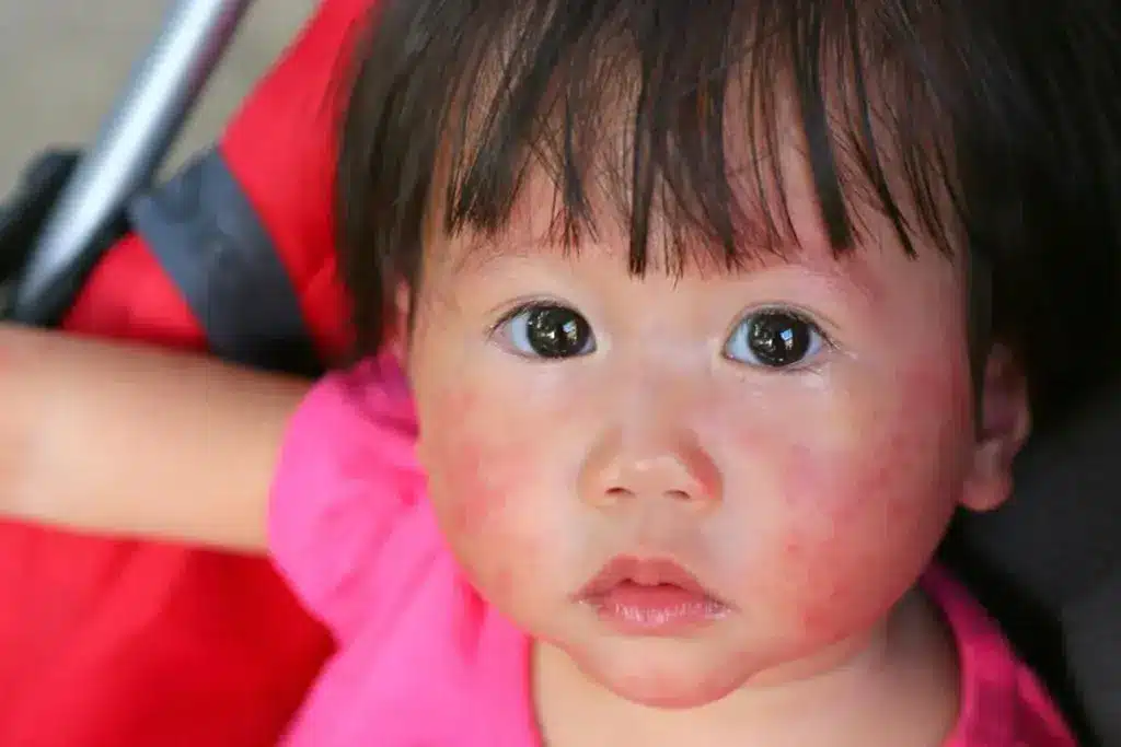 Sharp What Is The Ice Test For Urticaria (Cold Urticaria)?