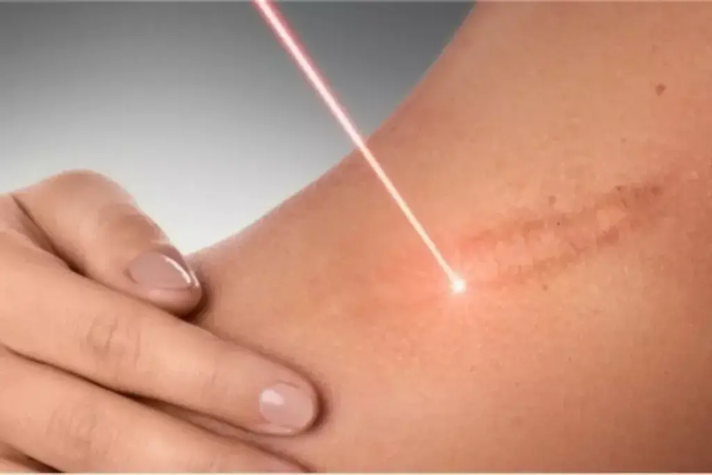 How to Get Face Lasered: Benefits and What to Expect 2 How to Get Face Lasered: Benefits and What to Expect