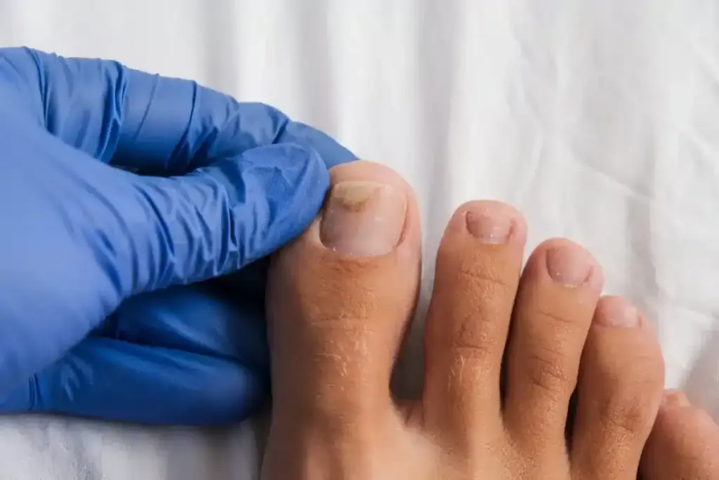 Fascinating What Kills Toenail Fungus Instantly?