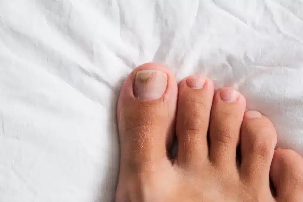 Fascinating What Kills Toenail Fungus Instantly?