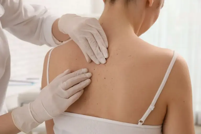 Ultimate Why Would A Dermatologist Do A Punch Biopsy?