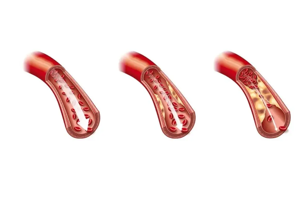 Lipitor: Best Plaque Reduction Insights 1 Lipitor: Best Plaque Reduction Insights